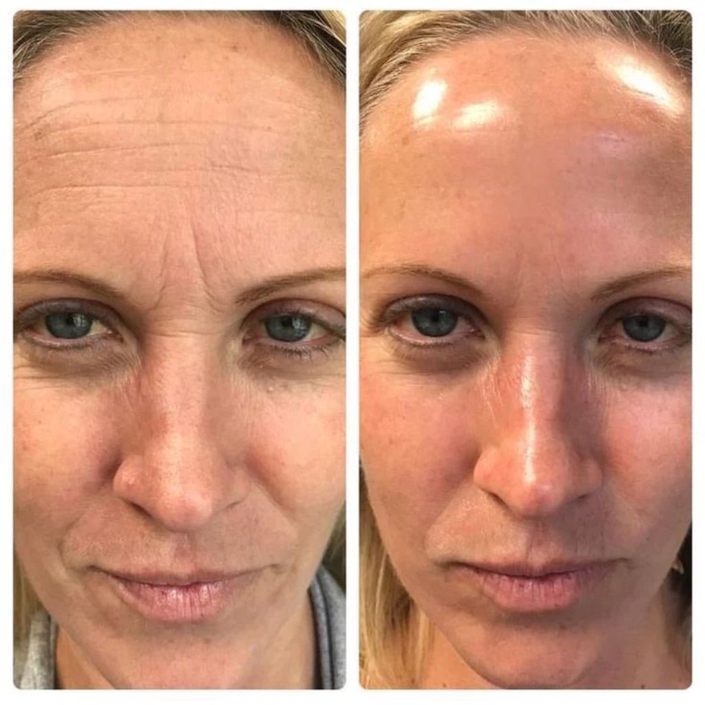 Retinal Shot - Dile Adiós a las Arrugas 😱50% DE DESCUENTO😱