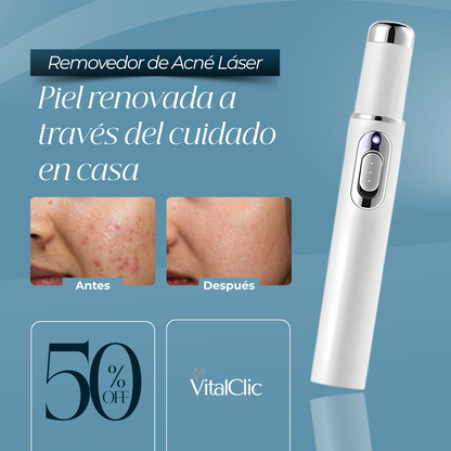 Removedor de Acné Láser - DILE ADIÓS AL ACNÉ EN SEGUNDOS 😱50% DE DESCUENTO😱